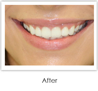 Invisalign Springfield - Invisalign Case 1 After