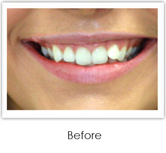 Invisalign Springfield - Invisalign Case 1 Before