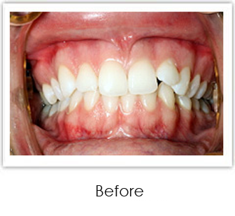 Invisalign Springfield - Invisalign Case 2 Before