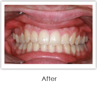 Invisalign Springfield - Invisalign Case 3 After