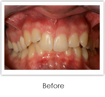 Invisalign Springfield - Invisalign Case 3 Before