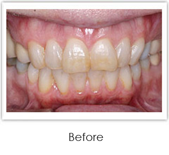Teeth Whitening Springfield MA - Teeth Whitening Case 1 Before